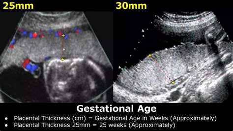 how to measure placental thickness|placental thickness and gestational age.